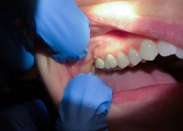 Best Emergency Dental Care for Broken or Chipped Teeth in Eastlawn Gardens, PA